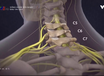 Sống khỏe mỗi ngày: Đau vai gáy